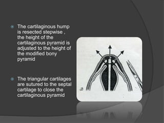  The cartilaginous hump
is resected stepwise ,
the height of the
cartilaginous pyramid is
adjusted to the height of
the modified bony
pyramid
 The triangular cartilages
are sutured to the septal
cartilage to close the
cartilaginous pyramid
 