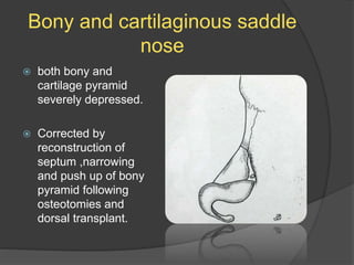 Bony and cartilaginous saddle
nose
 both bony and
cartilage pyramid
severely depressed.
 Corrected by
reconstruction of
septum ,narrowing
and push up of bony
pyramid following
osteotomies and
dorsal transplant.
 