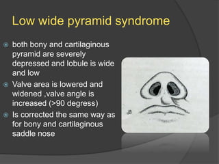 Low wide pyramid syndrome
 both bony and cartilaginous
pyramid are severely
depressed and lobule is wide
and low
 Valve area is lowered and
widened ,valve angle is
increased (>90 degress)
 Is corrected the same way as
for bony and cartilaginous
saddle nose
 