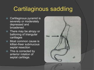 Cartilaginous saddling
 Cartilaginous pyramid is
severely or moderately
depressed and
broadened .
 There may be atropy or
balloning of triangular
cartilages
 Most common cause is
killian-freer submucous
septal resection
 This is corrected by
anterior rotation of
septal cartilage.
 