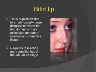 Bifid tip
 Tip is duplicated due
to an abnormally large
distance between the
two domes with an
excessive amount of
interdomal connective
tissue.
 Requires dissection
and repositioning of
the lobular cartilage
 