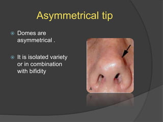 Asymmetrical tip
 Domes are
asymmetrical .
 It is isolated variety
or in combination
with bifidity
 
