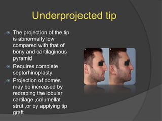 Underprojected tip
 The projection of the tip
is abnormally low
compared with that of
bony and cartilaginous
pyramid
 Requires complete
septorhinoplasty
 Projection of domes
may be increased by
redraping the lobular
cartilage ,columellat
strut ,or by applying tip
graft
 