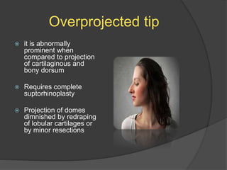 Overprojected tip
 it is abnormally
prominent when
compared to projection
of cartilaginous and
bony dorsum
 Requires complete
suptorhinoplasty
 Projection of domes
dimnished by redraping
of lobular cartilages or
by minor resections
 
