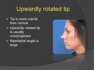 Upwardly rotated tip
 Tip is more cranial
than normal
 Upwardly rotated tip
is usually
overprojected
 Nasolabial angle is
large
 