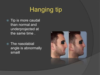 Hanging tip
 Tip is more caudal
than normal and
underprojected at
the same time .
 The nasolabial
angle is abnormally
smaill
 