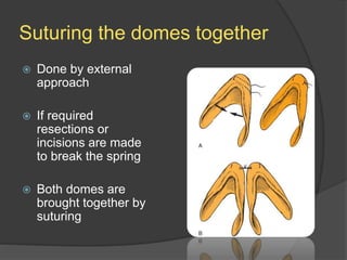 Suturing the domes together
 Done by external
approach
 If required
resections or
incisions are made
to break the spring
 Both domes are
brought together by
suturing
 