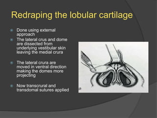 Redraping the lobular cartilage
 Done using external
approach
 The lateral crus and dome
are dissected from
underlying vestibular skin
leaving the medial crura
 The lateral crura are
moved in ventral direction
making the domes more
projecting
 Now transcrural and
transdomal sutures applied
 