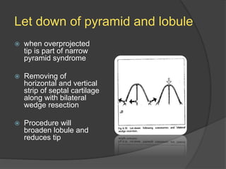 Let down of pyramid and lobule
 when overprojected
tip is part of narrow
pyramid syndrome
 Removing of
horizontal and vertical
strip of septal cartilage
along with bilateral
wedge resection
 Procedure will
broaden lobule and
reduces tip
 