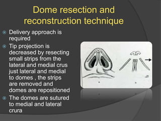 Dome resection and
reconstruction technique
 Delivery approach is
required
 Tip projection is
decreased by resecting
small strips from the
lateral and medial crus
just lateral and medial
to domes , the strips
are removed and
domes are repositioned
 The domes are sutured
to medial and lateral
crura
 