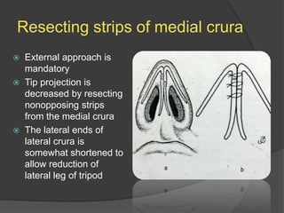 Resecting strips of medial crura
 External approach is
mandatory
 Tip projection is
decreased by resecting
nonopposing strips
from the medial crura
 The lateral ends of
lateral crura is
somewhat shortened to
allow reduction of
lateral leg of tripod
 