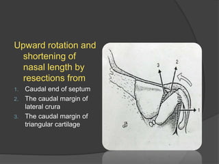Upward rotation and
shortening of
nasal length by
resections from
1. Caudal end of septum
2. The caudal margin of
lateral crura
3. The caudal margin of
triangular cartilage
 