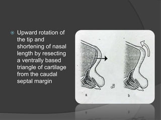  Upward rotation of
the tip and
shortening of nasal
length by resecting
a ventrally based
triangle of cartilage
from the caudal
septal margin
 