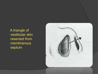 A triangle of
vestibular skin
resected from
membranous
septum
 