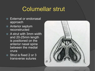 Columellar strut
 External or endonasal
approach
 Anterior septum
reconstructed
 A strut with 3mm width
and 20-25mm length
is positioned on the
anterior nasal spine
between the medial
crura
 Strut is fixed 2 or 3
transverse sutures
 