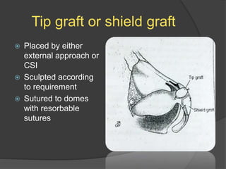 Tip graft or shield graft
 Placed by either
external approach or
CSI
 Sculpted according
to requirement
 Sutured to domes
with resorbable
sutures
 