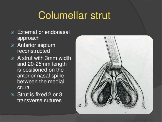 Rhinoplasty Raju Ppt Full Rhinoplasty Raju Ppt Full