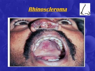 Rhinoscleroma
 