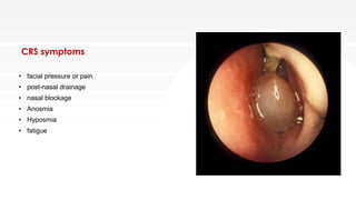 CRS symptoms
• facial pressure or pain
• post-nasal drainage
• nasal blockage
• Anosmia
• Hyposmia
• fatigue
 