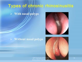 Types of chronic rhinosinusitis
 With nasal polyps

 Without nasal polyps

GP Trainees 27/11/13,
Education Centre RPH

14

 