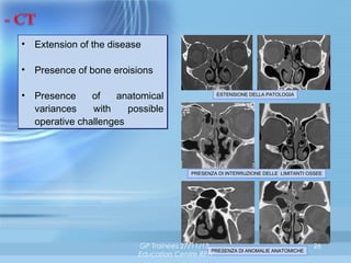 • Extension of the disease
• Presence of bone eroisions
• Presence
of
anatomical
variances
with
possible
operative challenges

ESTENSIONE DELLA PATOLOGIA

PRESENZA DI INTERRUZIONE DELLE LIMITANTI OSSEE

GP Trainees 27/11/13,
PRESENZA DI ANOMALIE ANATOMICHE
Education Centre RPH

26

 