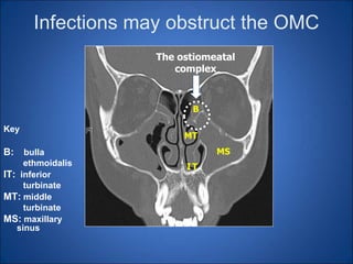 Omc Complex Rhinosinusitis Management. WAC.12-11 (1).ppt