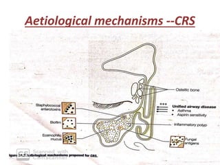 Aetiological mechanisms --CRS
 