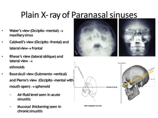 Plain X-rayof Paranasal sinuses
• Plain X-rayofParanasalsinuses• Water’s view (Occipito -mental) 
maxillarysinus
• Caldwell’s view (Occipito -frontal) and
lateralviewfrontal
• Rhese’s view (lateral oblique) and
lateral view 
ethmoids
• Baseskull view (Submento -vertical)
and Pierre’s view (Occipito -mental with
mouth open) sphenoid
− Air-fluid level seen in acute
sinusitis
− Mucosal thickening seen in
chronicsinusitis
 