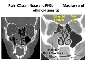 Plain C.T.scan NoseandPNS: Maxillaryand
ethmoidsinusitis
 