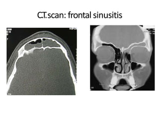 C.T.scan: frontalsinusitis
 
