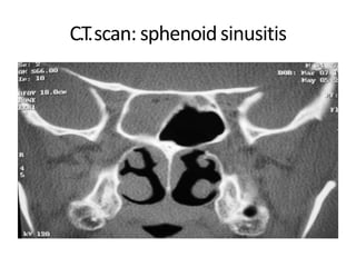 C.T.scan: sphenoidsinusitis
 