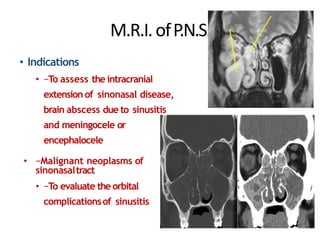M.R.I.ofP.N.S.
• Indications
• −To assess the intracranial
extension of sinonasal disease,
brain abscess due to sinusitis
and meningocele or
encephalocele
• −Malignant neoplasms of
sinonasaltract
• −To evaluate the orbital
complicationsof sinusitis
 