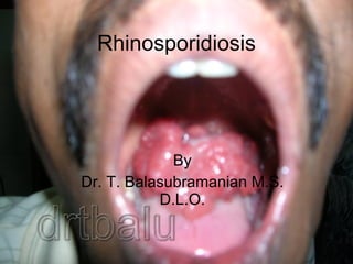 Rhinosporidiosis By Dr. T. Balasubramanian M.S. D.L.O. 