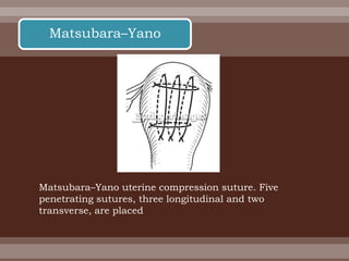 Matsubara–Yano uterine compression suture. Five
penetrating sutures, three longitudinal and two
transverse, are placed
Matsubara–Yano
 