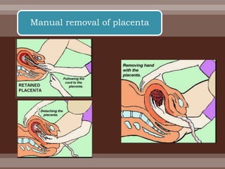Manual removal of placenta
 