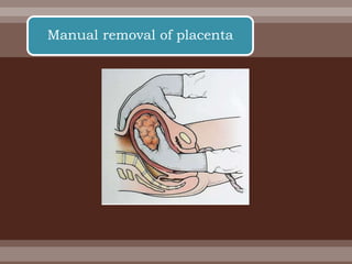 Manual removal of placenta
 