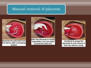 Manual removal of placenta
 