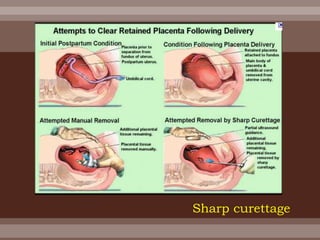 Sharp curettage
 