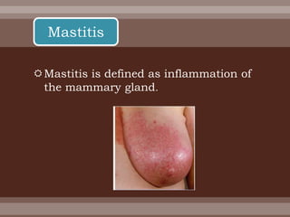 Mastitis is defined as inflammation of
the mammary gland.
Mastitis
 