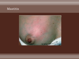 Mastitis
 