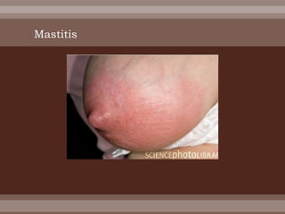 Mastitis
 