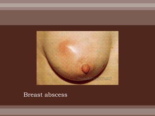 Breast abscess
 