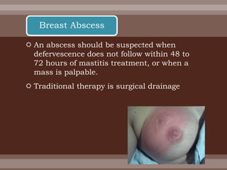  An abscess should be suspected when
defervescence does not follow within 48 to
72 hours of mastitis treatment, or when a
mass is palpable.
 Traditional therapy is surgical drainage
Breast Abscess
 