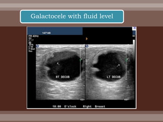 Galactocele with fluid level
 
