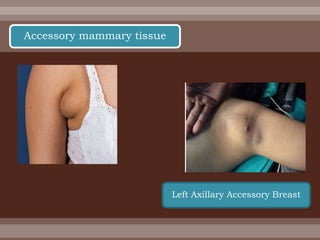 Accessory mammary tissue
Left Axillary Accessory Breast
 