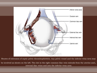 Routes of extension of septic pelvic thrombophlebitis. Any pelvic vessel and the inferior vena cava may
be involved as shown on the left. The clot in the right common iliac vein extends from the uterine and.
internal iliac veins and into the inferior vena cava
 