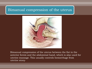 Bimanual compression of the uterus between the fist in the
anterior fornix and the abdominal hand, which is also used for
uterine massage. This usually controls hemorrhage from
uterine atony
Bimanual compression of the uterus
 