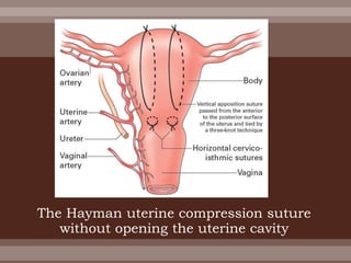 The Hayman uterine compression suture
without opening the uterine cavity
 