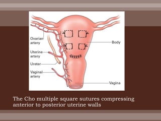 The Cho multiple square sutures compressing
anterior to posterior uterine walls
 