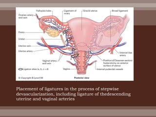 Placement of ligatures in the process of stepwise
devascularization, including ligature of thedescending
uterine and vaginal arteries
 